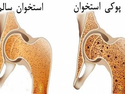 پوکی استخوان با تشخیص زود هنگام قابل درمان است